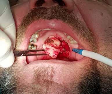 PP-050 Case Report: Excision of Pleomorphic Adenoma by using Electrocautery Bülent Kahraman, Ali Ekemen, Orkhan Ismayilov, Burak Mahir Maho, Hakan Alpay Karasu Ankara University,Faculty of Dentistry,