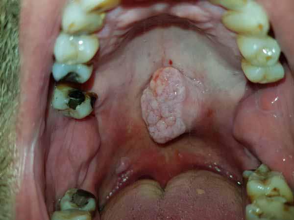 preoperative