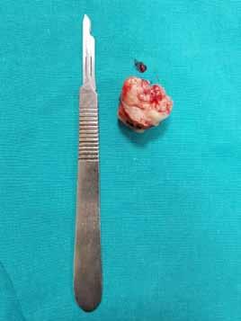 lesion