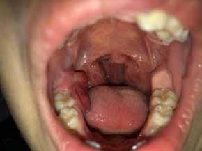 PP-051 A Case Report: Diagnosis and Follow up of Rabdomyosarcoma Raha Akbarihamed, Ali Ekemen, Orkhan Ismayilov, Hakan Alpay Karasu Ankara University, Faculty of Dentistry, Department of Oral and