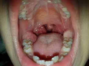 World Health Organization (WHO) divides rhabdomyosarcomas into three main groups: embryonal, alveolar and pleomorphic.