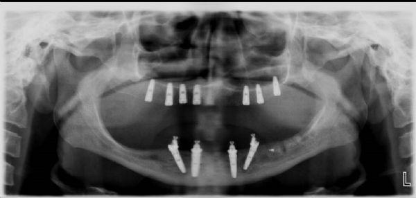 PP-053 Rehabilitation with All on Four Technique After Reconstruction of the Alveolar Bone which is Insufficient Vertical and Horizontal with Iliac Bone Graft Irem Alan, Ali Ekemen, Orkhan Ismayilov,