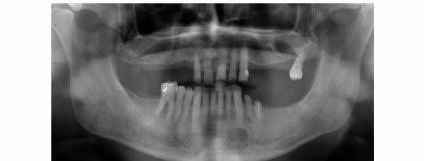 PP-069 Stafne Bone Cyst in Rare Location Nagehan Burcu Öğütcü Baskent University Konya Research and Application Center Objective: Stafne bone cysts (SBC) are defined as pseudocysts of the jaw.