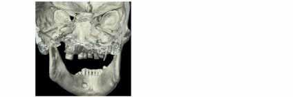 extended towards the medulla of the bo