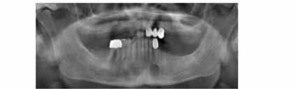 In this slice sublingual gland tissue invagination to the