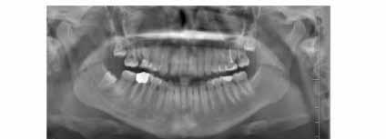 PP-075 An Odontogenic Cyst Mimicking Maxillary Sinus Tumor: Case Report Nagehan Burcu Öğütcü, Mehmet Volkan Akdoğan Baskent University Konya Research and Application Center Objective: Odontogenic