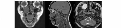 In this case report, possible differential diagnosis and treatment process of a lesion that localized in the maxillary sinus were discussed.