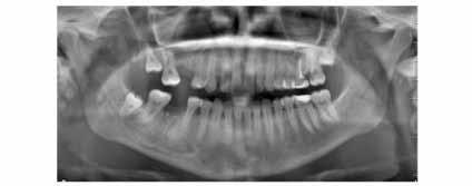 Figure 3 A year after the control panoramic radiograph has show a