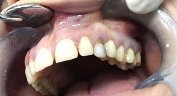 PP-079 Large Dentigerous Cyst Associated with Ectopic Canine of the Maxilla:A Case Report Rıdvan Güler, Bekir İlyas, Kamil Serkan Ağaçayak Dicle University, Faculty of Dentistry, Departmant of Oral