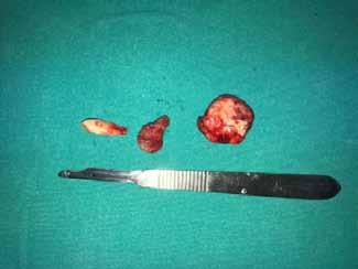 intraoperative