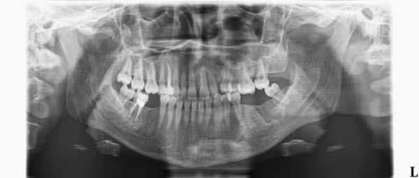 Postoperative