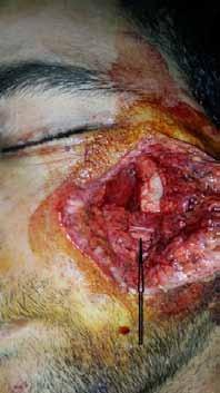 PP-114 An Ironic Injury with Car Washing Compressor Neşet Akay 1, Hatice Güzelküçük Akay 2 1 Department of Oral and Maxillofacial Surgergy, Faculty of Dentistry, Bolu Abant İzzet Baysal University,