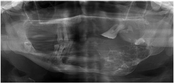 PP-121 An Extencive Multicystic Ameloblastoma in Mandible: A Case Report Neşet Akay, Selda Akkaya Oral & Maxillofacial Surgery Department, Faculty of Dentistry,Bolu Abant Izzet Baysal University,