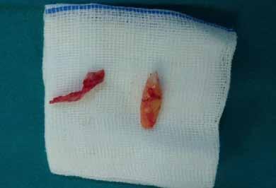 PP-123 Dentigerous Cyst Associated With A Transmigrated Canine Of The Mandibular Symphysis: A Case Report Rıdvan Güler, Osman Habek, Bekir İlyas, Kamil Serkan Ağacayak Dicle University, Faculty of