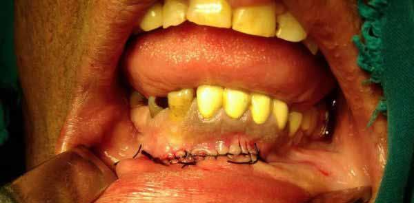 intraoperative