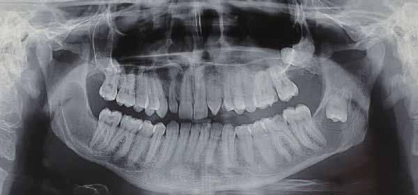 PP-125 Recurrent Keratocysts of the Mandible in Association with Gorlin-Goltz (Nevoid basal-cell carcinoma syndrome) Syndrome: A Case Report Selin Kumral, Fian Derviş, Hakkı Tanyeri Department of