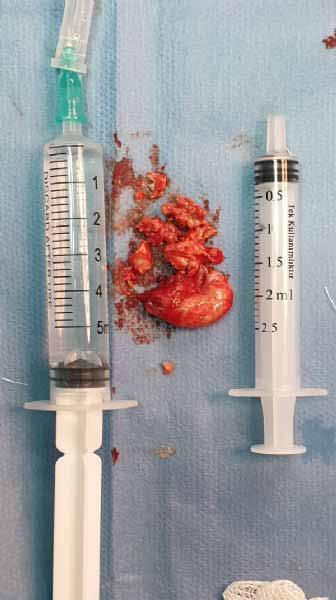 Resim 8 Lesion