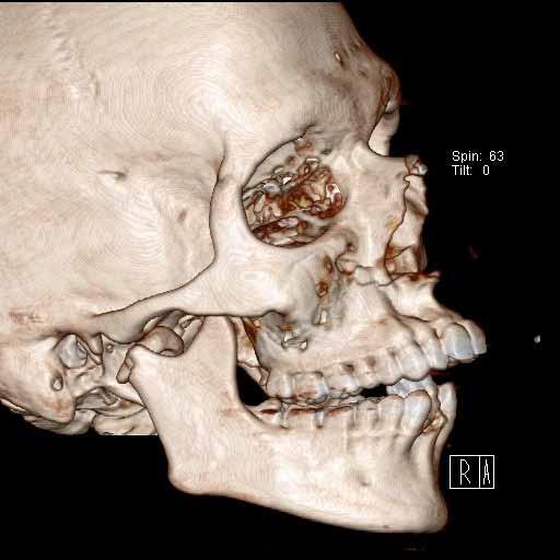 Figure 1 Three- dimensional facial bone CT imaging showing Le Fort I maxillary fracture,