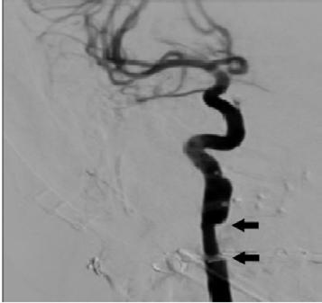lower anterior segment Figure 2 Selective angiogram of the right internal carotid artery