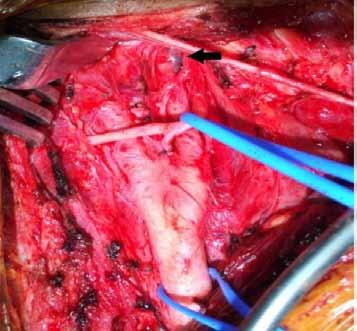 Figure 3 Intraoperative surgical exposure demonstrating dissecting aneurysm
