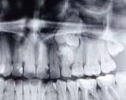 PP-129 Complex Odontoma Enucleation and Canine Tooth Autotransplantation Kübra Karakuzu, Nazife Begüm Karan Department of Oral&Maxillofacial Surgery, RTE University, Rize, Turkey Objective: Odontoma