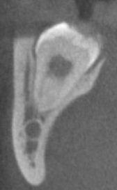 OP-020 The Assessment of The Position of The Mandibular Canal And Mandibular Third Molar On Cone-Beam Computed Tomography Images Dilek Menziletoğlu, Tolgahan Çayır Oral and Maxillofacial Surgery,
