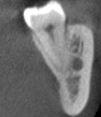 molar on cone-beam computed tomography images.
