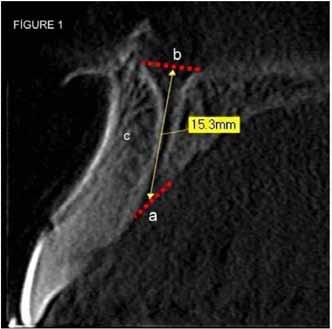 figure 1 The sagittal section shows the measurements of the length of the nasopalatine canal and the anteroposterior diameter of the canal at the nasal