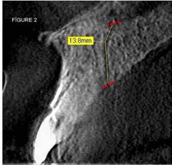 Measurements of the incisive foramen, nasopalatine foramen and incisive canal length on sagittal section CBCT; a) The diameter of the incisive foramen.