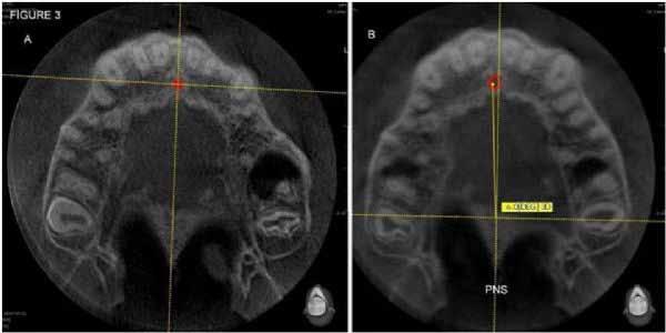 Figure 3 The amount of incisive foramen displacement was calculated by measuring the angle of the linear line drawn by the spinal nasalis posteriorly from the center of the incisive foramen.