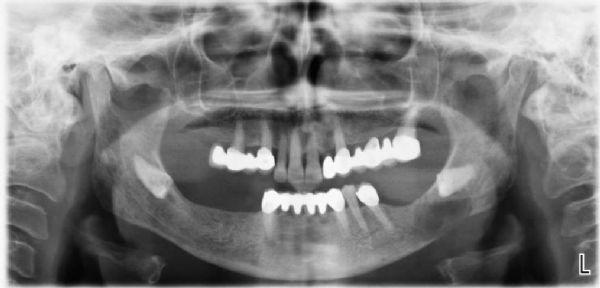 OP-046 Pathologic Fracture of the Mandible in a Multiple Myeloma Patient Osman Akıncı 1, Poyzan Bozkurt 1, Ramazan Arslan 1, Emrah Mansuroğlu 1, Çağıl Vural 2, Onur Özgüral 3, Reha Şükrü Kişnişci 1 1