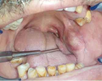 OP-049 Low Grade Mucoepidermoid Carcinoma and Glandular Odontojenic Cyst: Comparison of Two Cases Kübra Karakuzu, Nazife Begüm Karan Department of Oral&Maxillofacial Surgery, RTE University, Rize,