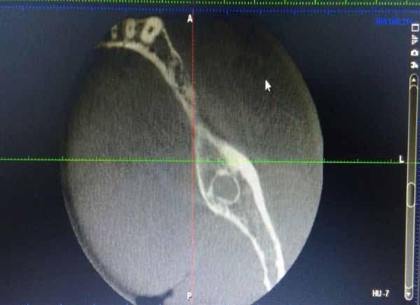 Figure 3 Intraosseous