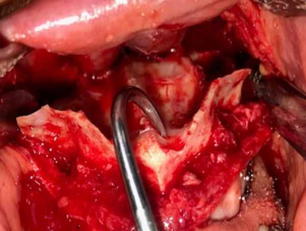 OP-050 The Effect of Modified High Lefort 1 Osteotomy in Mid- Face Deficiency Nazife Begüm Karan, Çiğdem Köşe Department of Oral&Maxillofacial Surgery, RTE University, Rize, Turkey Objective: