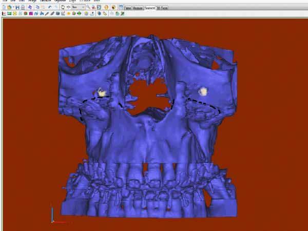 Figure 2 Postoperative 3D image.