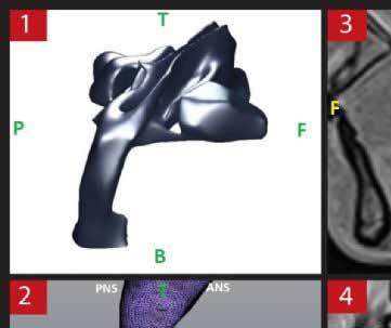 OP-051 Evaluation of Posterior Airway Space after Setback Surgery by Simulation Nazife Begüm Karan 1, Sevil Kahraman 2 1 RTE University, Faculty of Dentistry, Department of Oral&Maxillofacial Surgery
