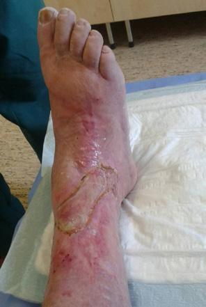 diabetes foot bőrpír kezelése)