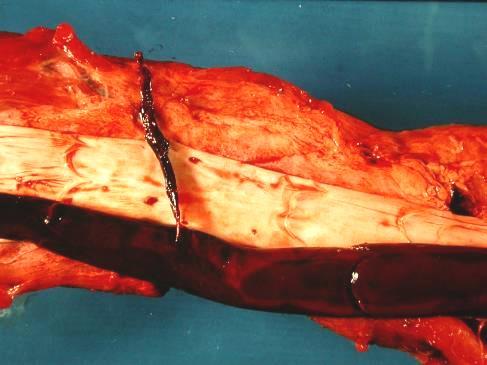 lardacea (borostyán) a thrombocyták szétesése indítja szívben és nagyobb