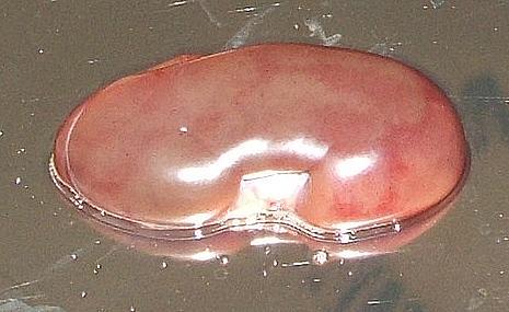 A malacok súlyosan lesoványodtak, öt malacnál vérzéses nyirokcsomókat és gyulladásos bélszakaszokat találtunk, valamint négy állat esetében a bőrben (1. kép), a vesékben (2. kép) és a lépben (3.