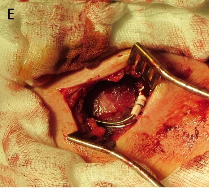 11. ábra: Pacemaker implantáció menete. A: Metszés és feltárás után a pectoralis fascia és a sulcus deltoideopectoralis látszik B: Kipreparált vena cephalica. A pacemaker zseb előkészítve.