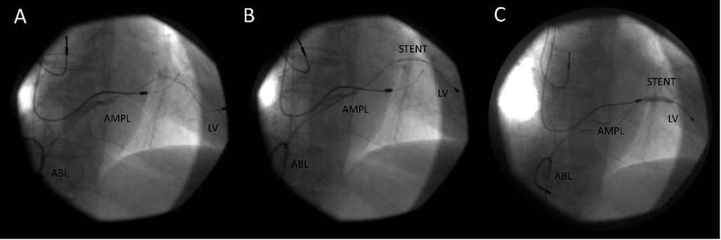 18. Ábra: bal kamrai MILR eljárás ABL: ablációs katéter, AMPL: amplatz guide, STENT: stent A: Kiindulási bal kamrai elektróda pozíció.