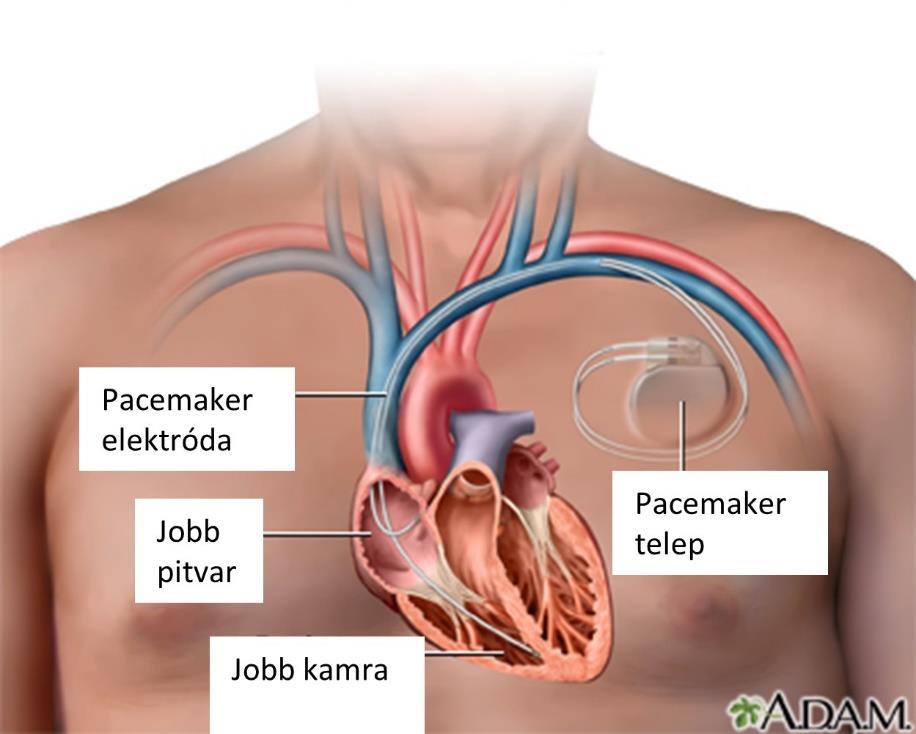 1. ábra: Pacemaker telep és endovascularis elektródák.
