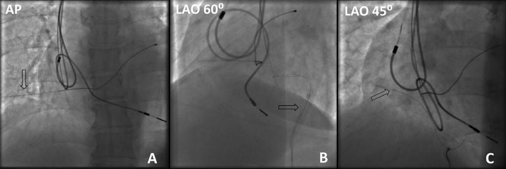 DDD pacemaker telepet implantáltunk a bal infracalvicularis régióba. Szövődmény nem jelentkezett, a beteget két nap múlva otthonába engedtük. 23.