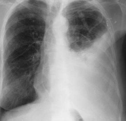 Pleurodesis Edith M. Marom, Edward F. Patz, Jr, Jeremy J.