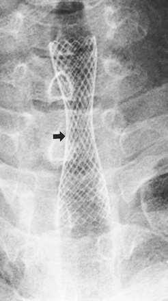 Tracheobronchial Strictures: Treatment with a Polyurethane-covered