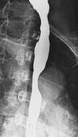 Stents in Patients with Benign Esophageal
