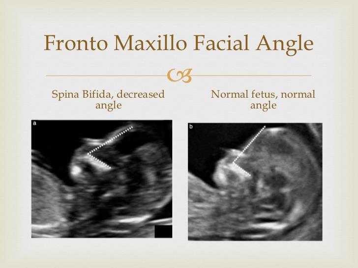 Alacsony FMF szög: Nyitott spina bifida gyanúja Frontomaxillary facial angle in fetuses with