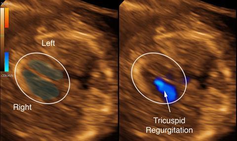 Tricuspidalis