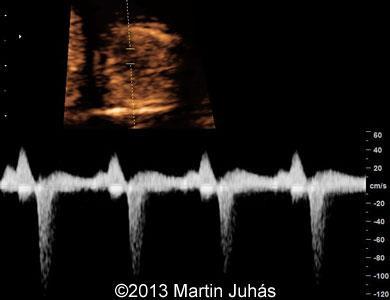 Tricuspidalis regurgitatio Systole