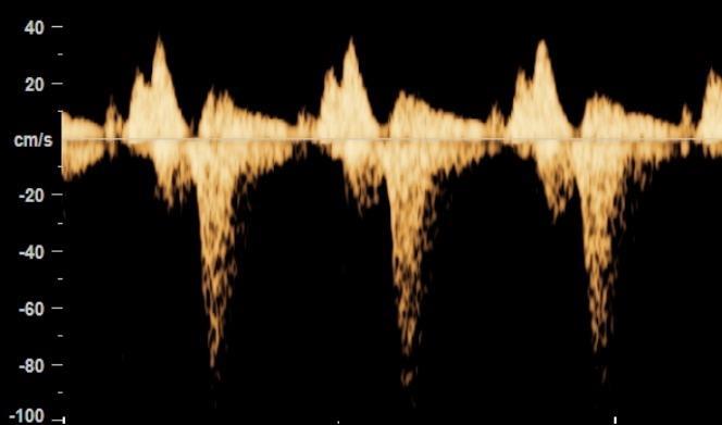 tricuspidalis billentyűn, mely a 60
